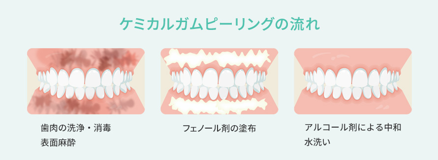 ケミカルガムピーリングの流れ