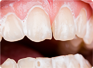 フッ素コート写真