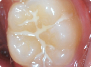 シーラント写真